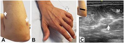 Gunshot-related nerve injuries of the upper extremities: clinical, electromyographic, and ultrasound features in 22 patients